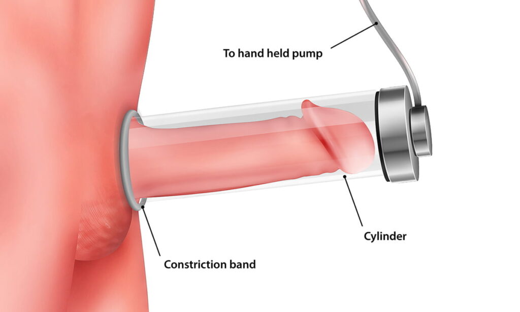 Vacuum Pump - publicpill Vacuum Pump Treat Erectile Dysfunction