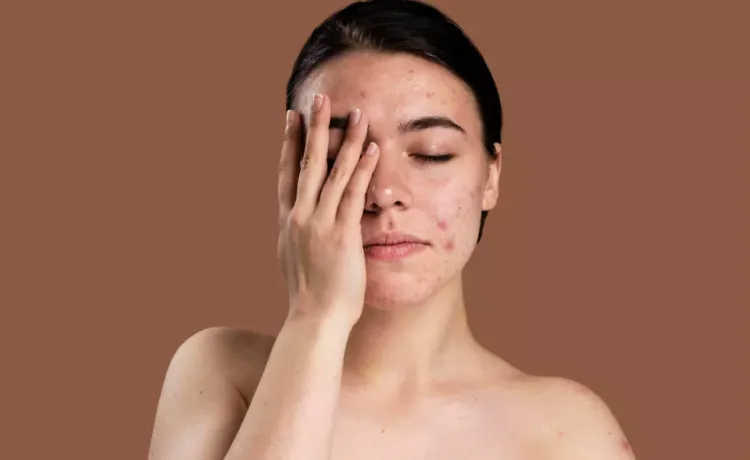 bhskin - Publicpill | #1 Trusted, Convenient, and affordable pharmacy, which Isotretinoin Brand is Best accutane 10