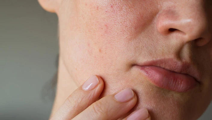 acne accutane 10