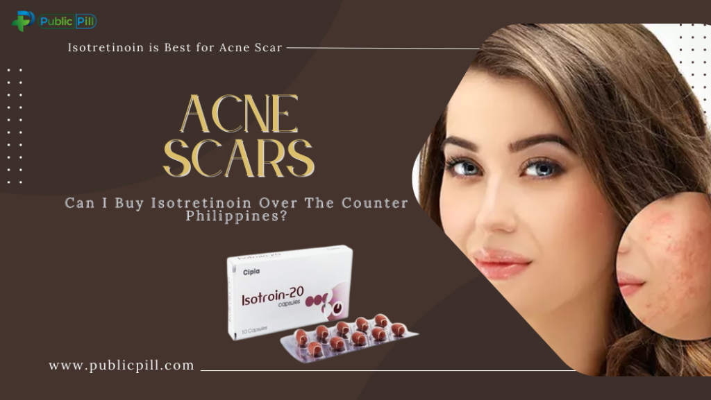 Acne Scars : Can I Buy Isotretinoin Over The Counter Philippines