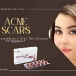 Acne Scars