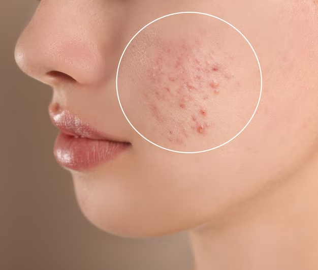 Benefits of Isotretinoin 20 What is isotretinoin 20 mg used for?