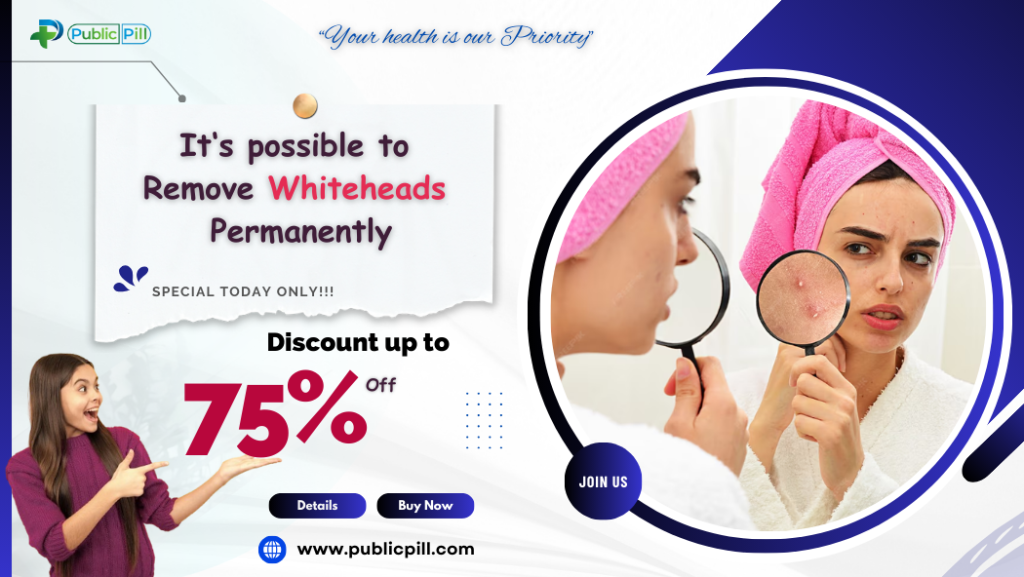 How to Remove Whiteheads Permanently