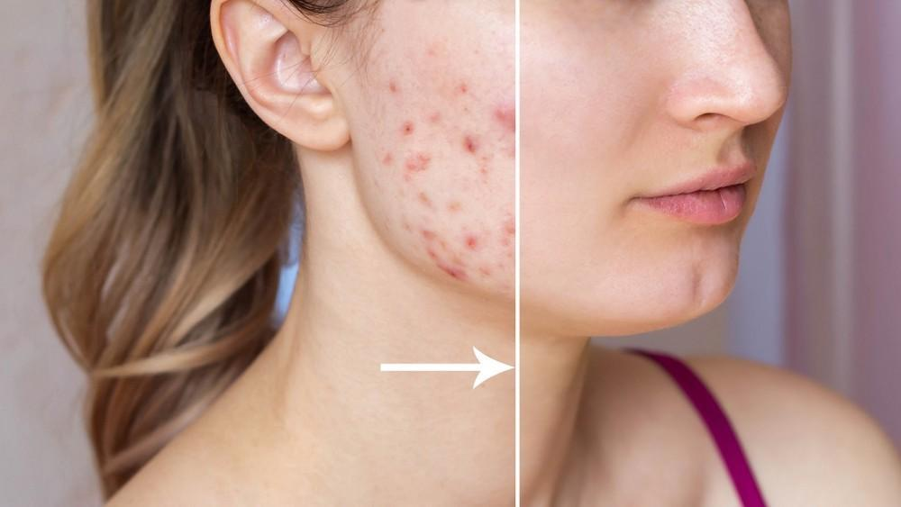 Hormonal Acne
