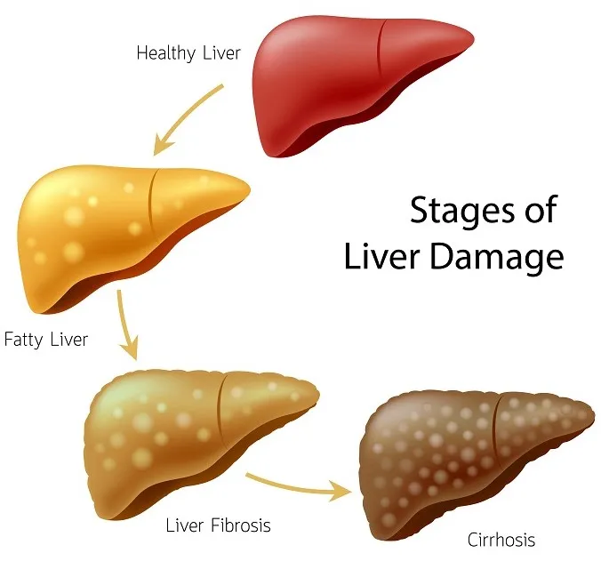 Liver Cancer Stages of Liver Damage: Liver Cancer