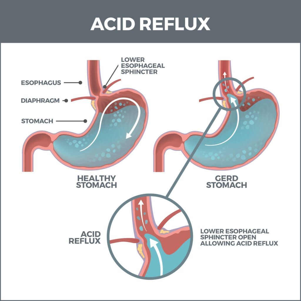 Heartburn (Acid Reflux) Heartburn (Acid Reflux)