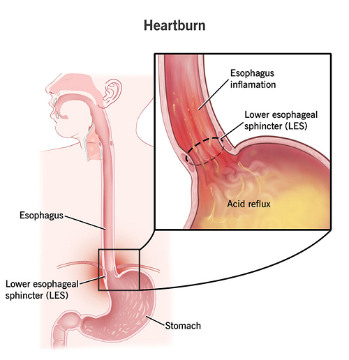 Heartburn Prevention Avoid These 6 Foods