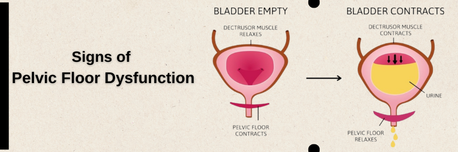 Sign of Pelvic Floor Disorders