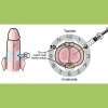 Bimix Injection - papaverine and phentolamine Bimix Injection - papaverine and phentolamine