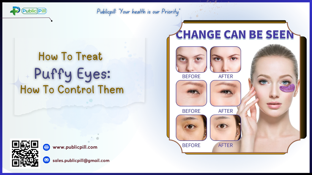 How To Treat Puffy Eyes How To Control Them - Publicpill | #1 Trusted, Convenient, and affordable pharmacy, How To Treat Puffy Eyes- How To Control Them