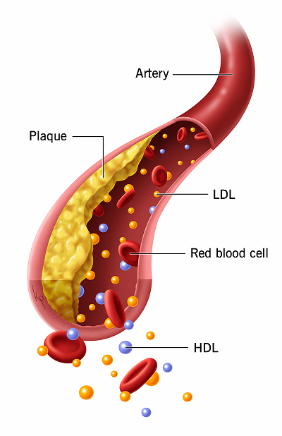 Excessive Lipid And Ldl cholesterol Ranges