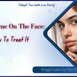 Fungal Acne On The Face How To Treat It - Publicpill | #1 Trusted, Convenient, and affordable pharmacy, Fungal Acne On The Face How To Treat It