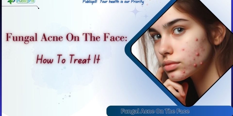 Fungal Acne On The Face How To Treat It - Publicpill | #1 Trusted, Convenient, and affordable pharmacy, Fungal Acne On The Face How To Treat It