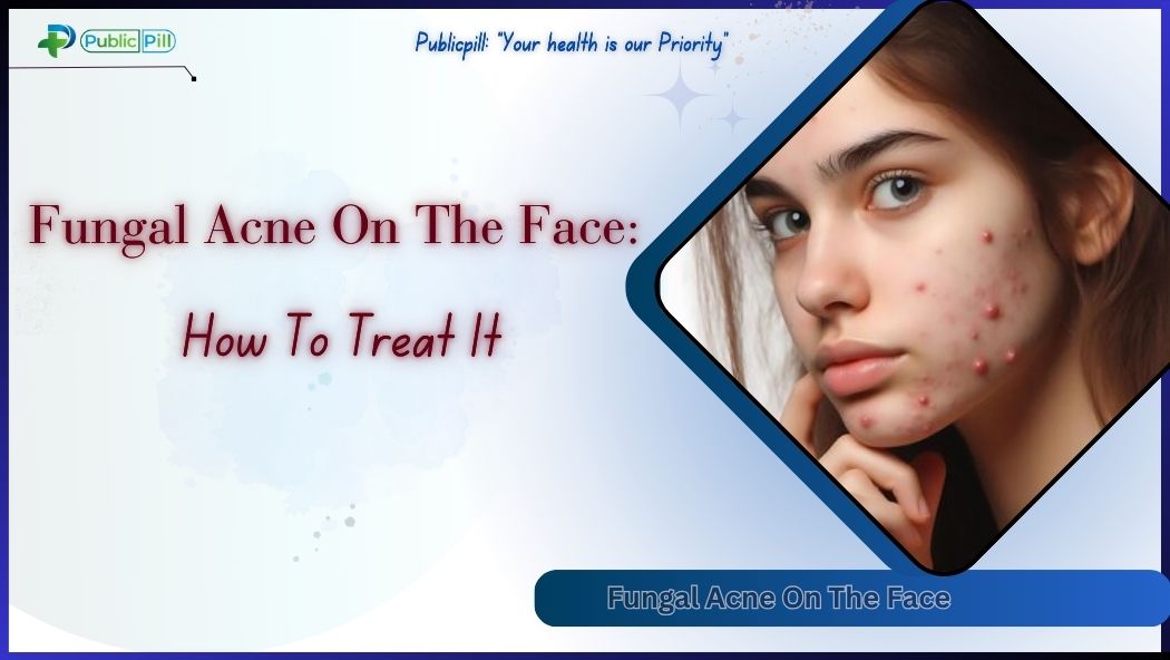 Fungal Acne On The Face How To Treat It - Publicpill | #1 Trusted, Convenient, and affordable pharmacy, Fungal Acne On The Face How To Treat It